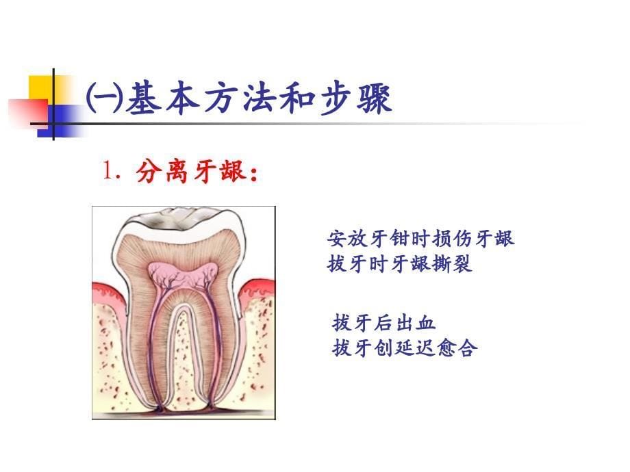 牙拔除术经典案例_第5页