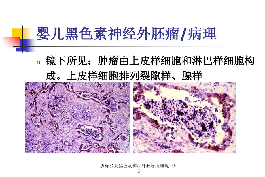 腺样婴儿黑色素神经外胚瘤病理镜下所见课件_第4页