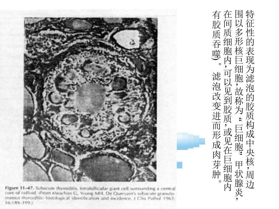 亚急性甲状腺炎五官科_第5页