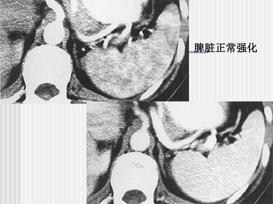 CT脾脏及其疾病_第5页