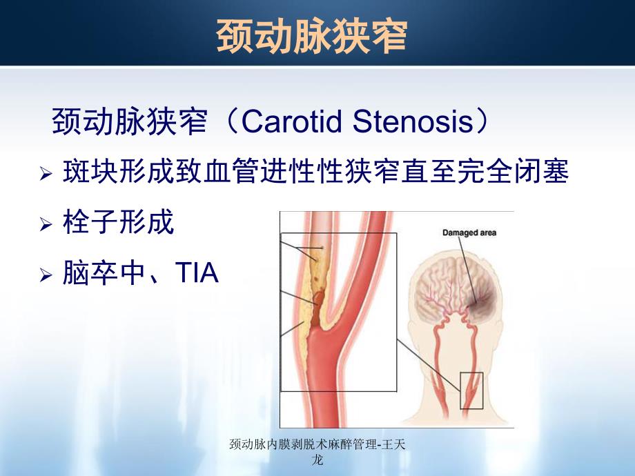 最新颈动脉内膜剥脱术麻醉管理王天龙PPT_第2页