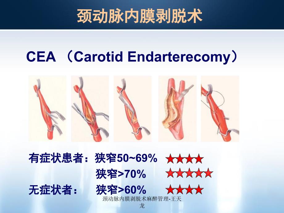 最新颈动脉内膜剥脱术麻醉管理王天龙PPT_第4页