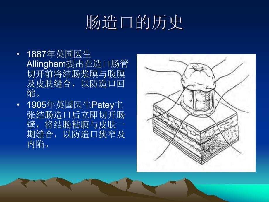 肠造口的护理_第5页