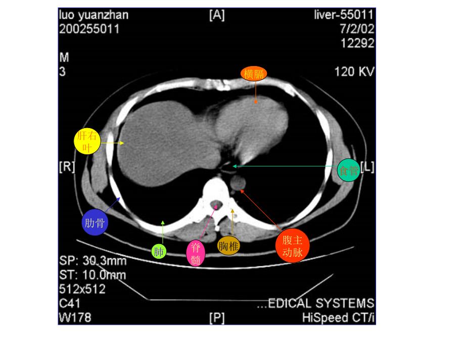 腹部CT断层解剖结构.ppt_第1页