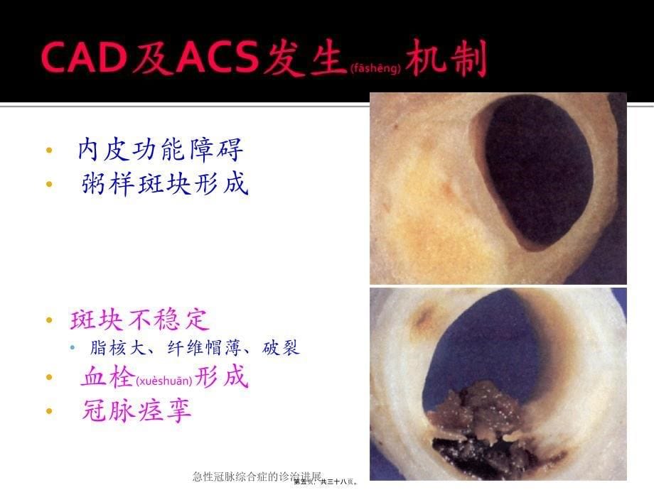 急性冠脉综合症的诊治进展课件_第5页