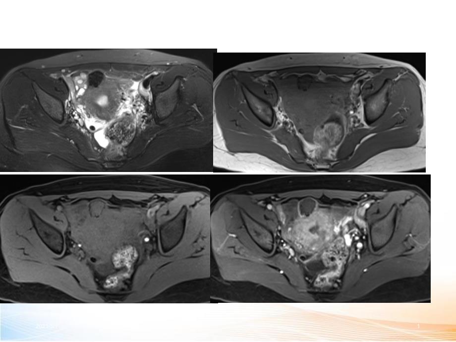 女性盆腔疾病MR读片_第1页