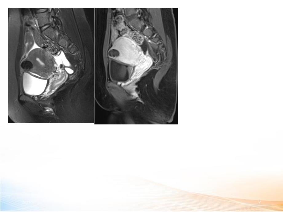 女性盆腔疾病MR读片_第2页