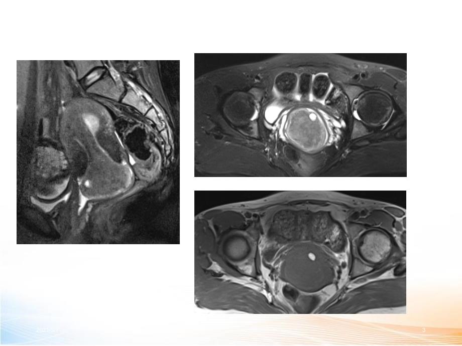 女性盆腔疾病MR读片_第3页