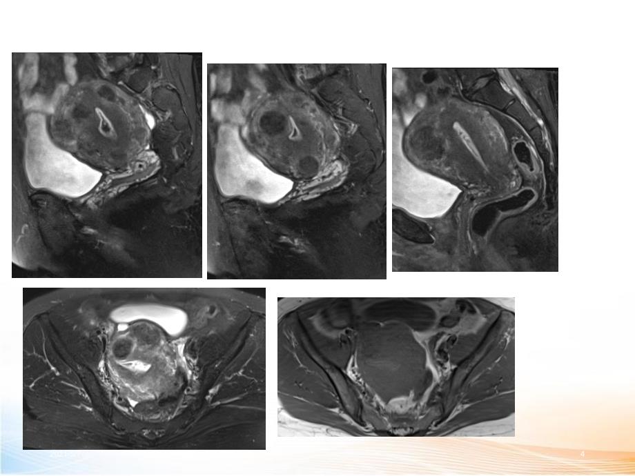 女性盆腔疾病MR读片_第4页