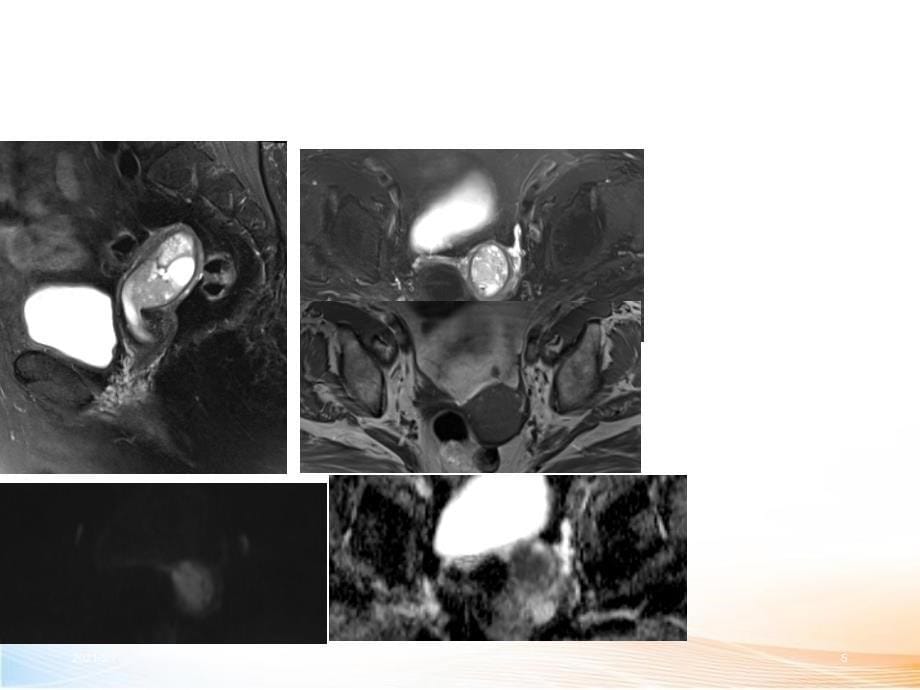 女性盆腔疾病MR读片_第5页