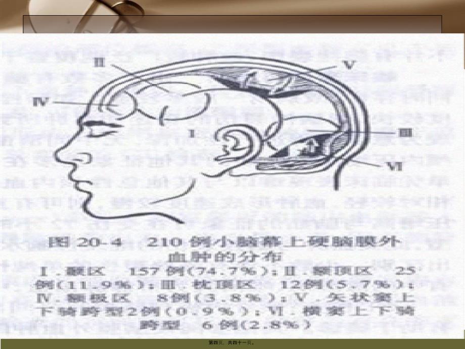 教学查房——创伤性硬膜外血肿课件_第4页