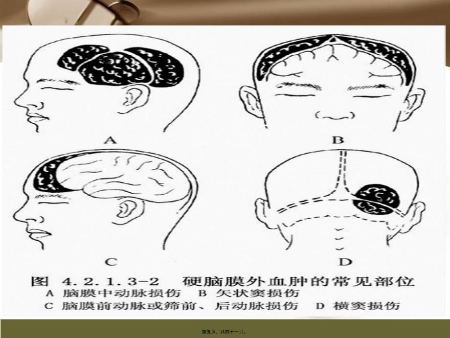 教学查房——创伤性硬膜外血肿课件_第5页