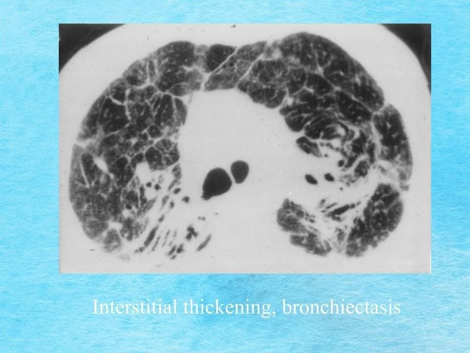 医学肺弥漫性病变ppt课件_第5页