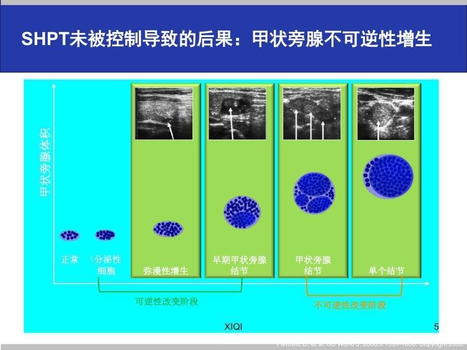 尿毒症继发甲状旁腺功能亢进的手术治疗_第5页