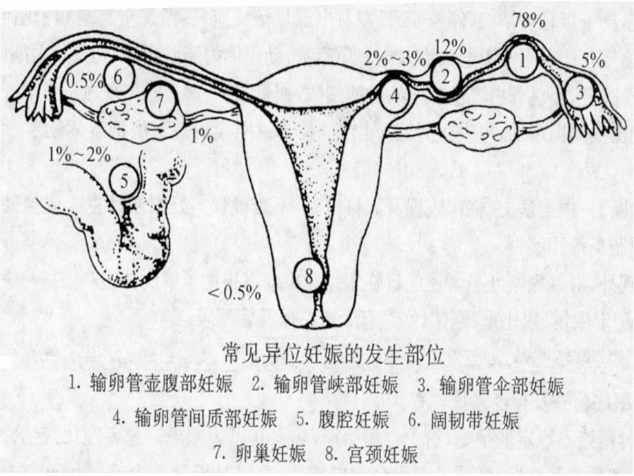 11异位妊娠总结_第4页