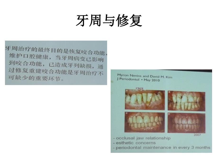 山东大学牙周病学课件02牙周健康与修复正畸治疗_第4页