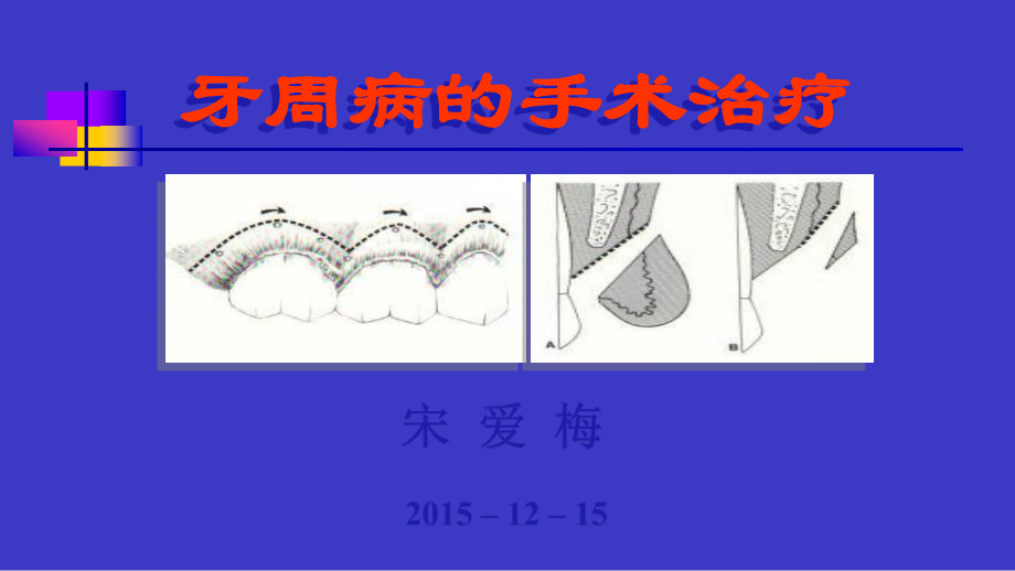 山东大学牙周病学课件15牙周病的手术治疗_第1页