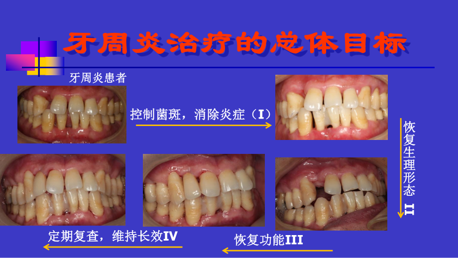 山东大学牙周病学课件15牙周病的手术治疗_第2页