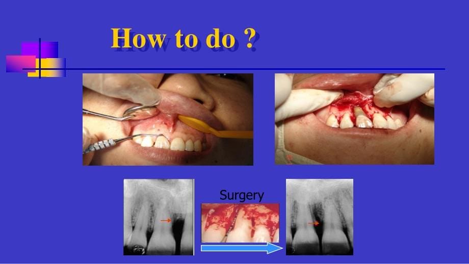 山东大学牙周病学课件15牙周病的手术治疗_第5页