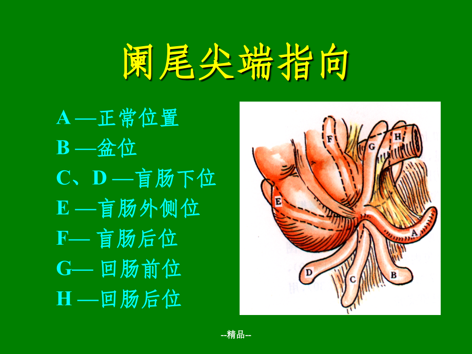 《阑尾炎全套》PPT课件_第4页