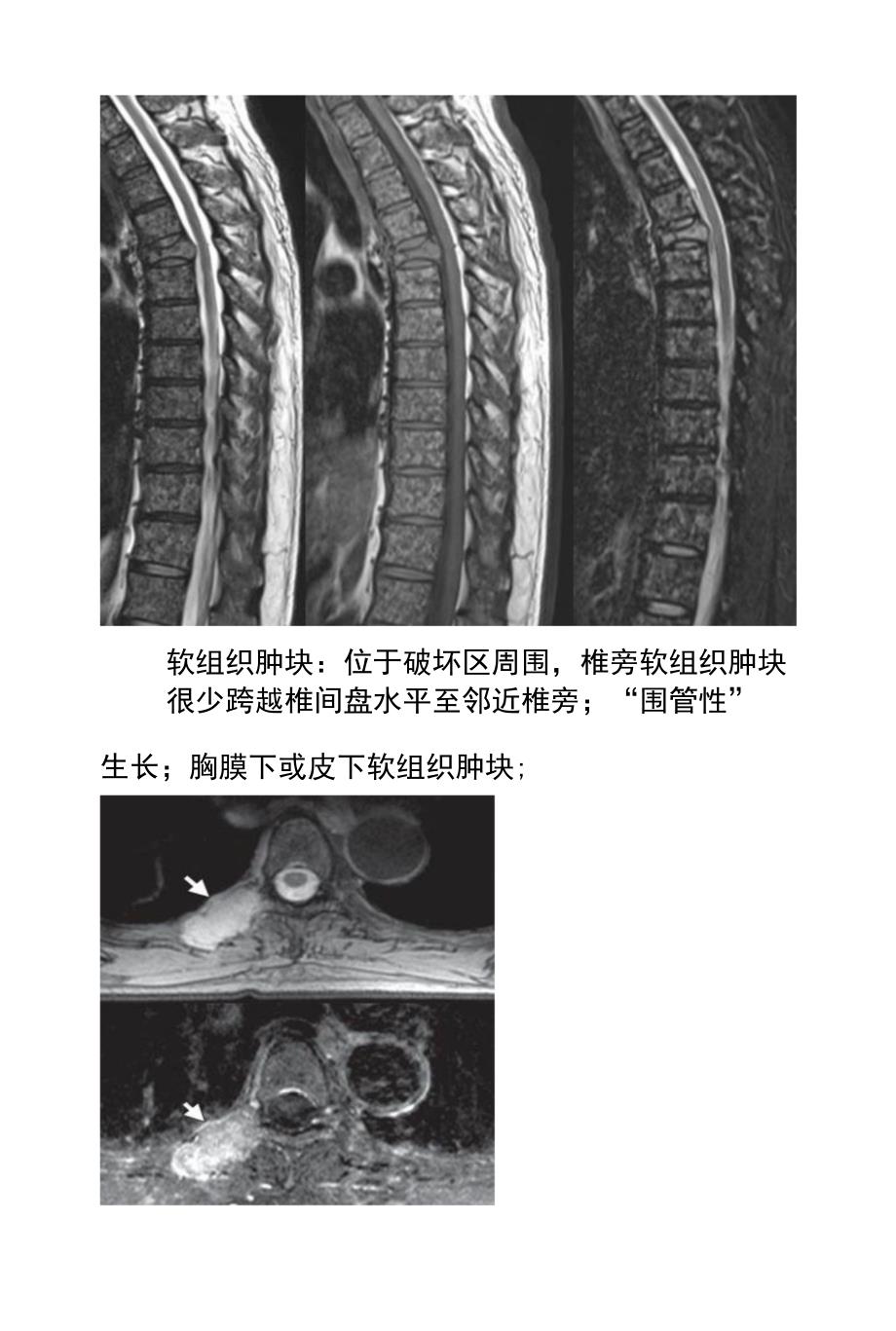 锥体骨髓瘤的影像学诊断及鉴别诊断_第2页