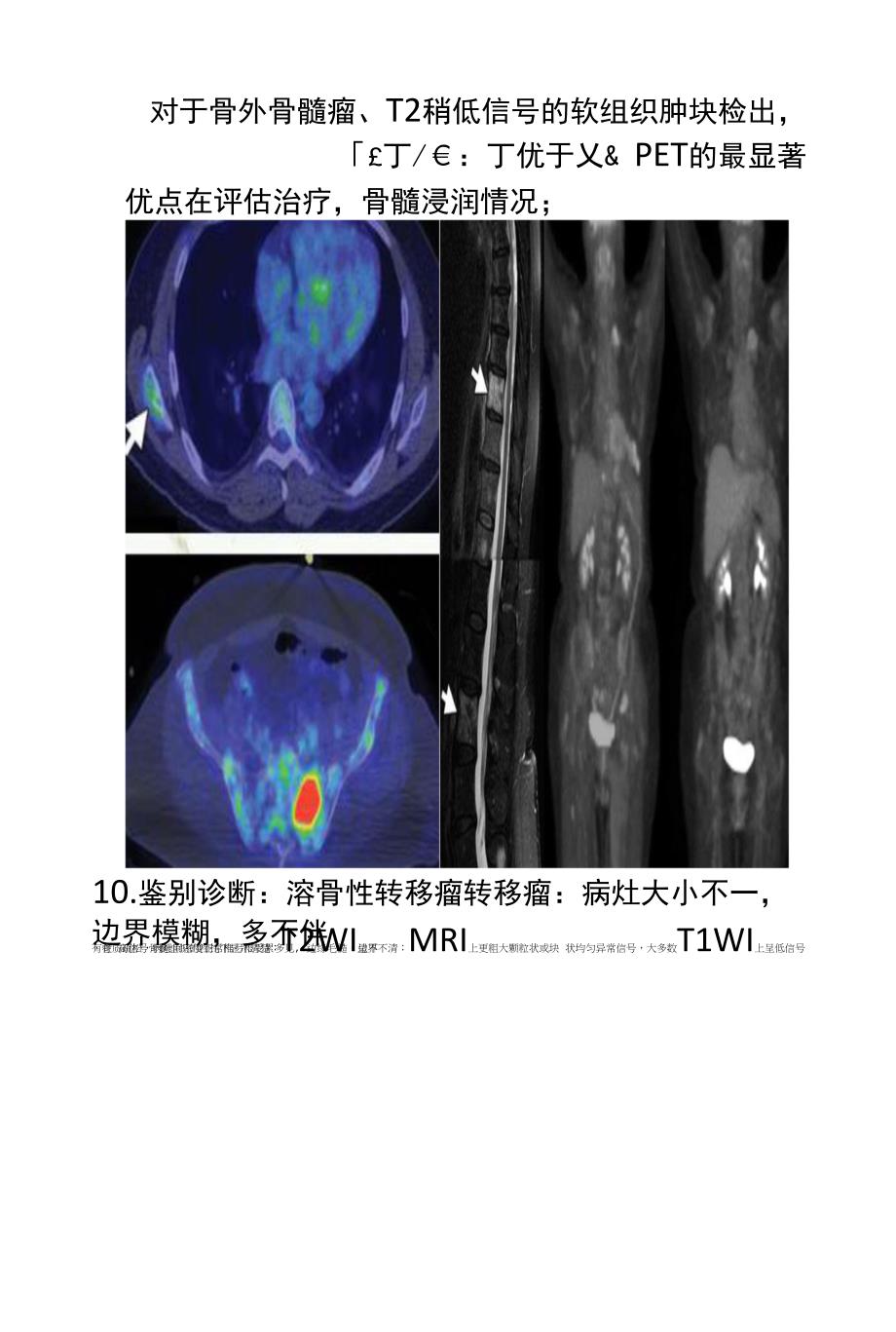 锥体骨髓瘤的影像学诊断及鉴别诊断_第4页