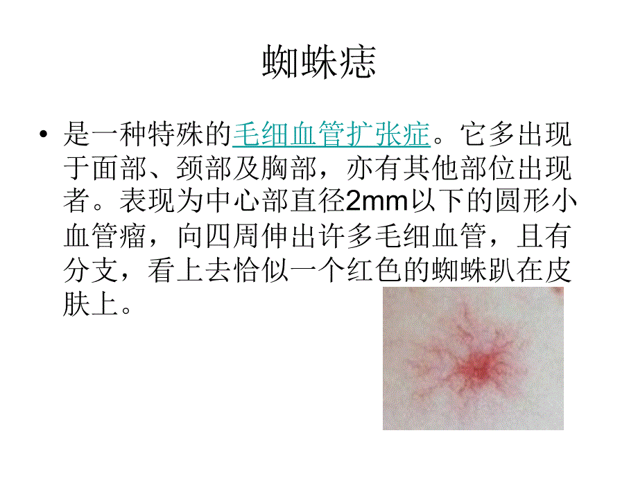 《蜘蛛痣出血点肝掌》PPT课件_第2页