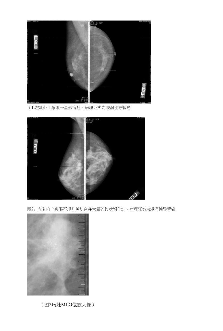 乳腺X线诊断的分析_第5页