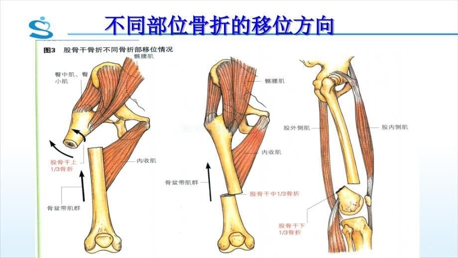 儿童股骨干PPT课件_第5页