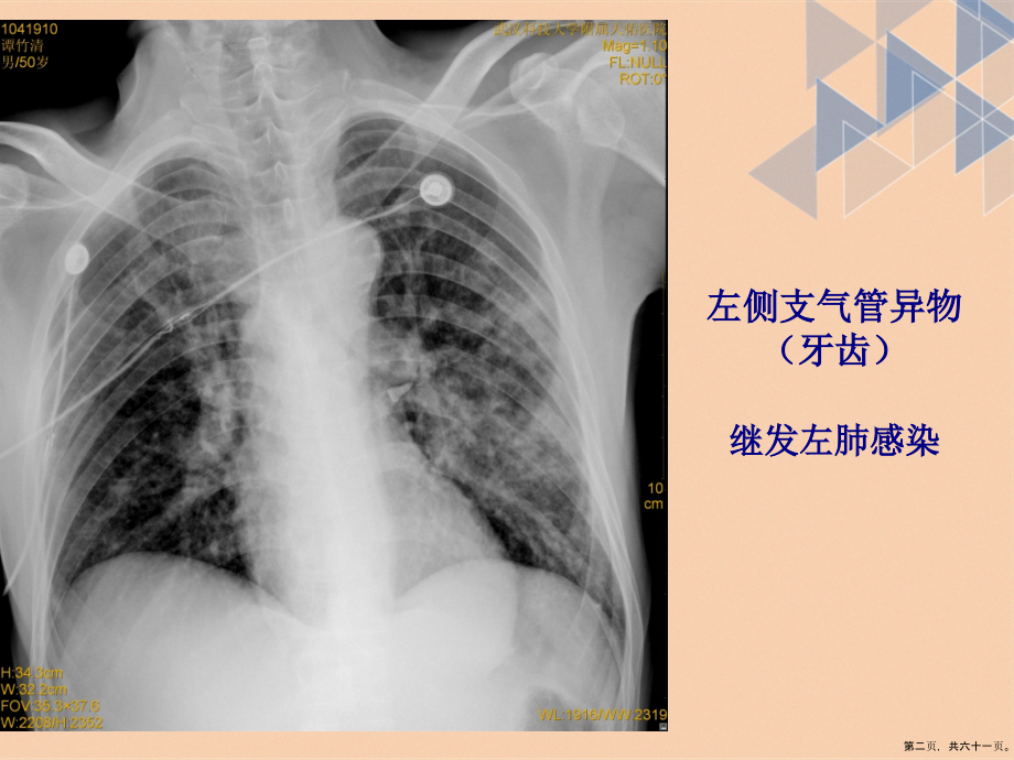 呼吸系统常见疾病影像诊断讲课文档_第2页