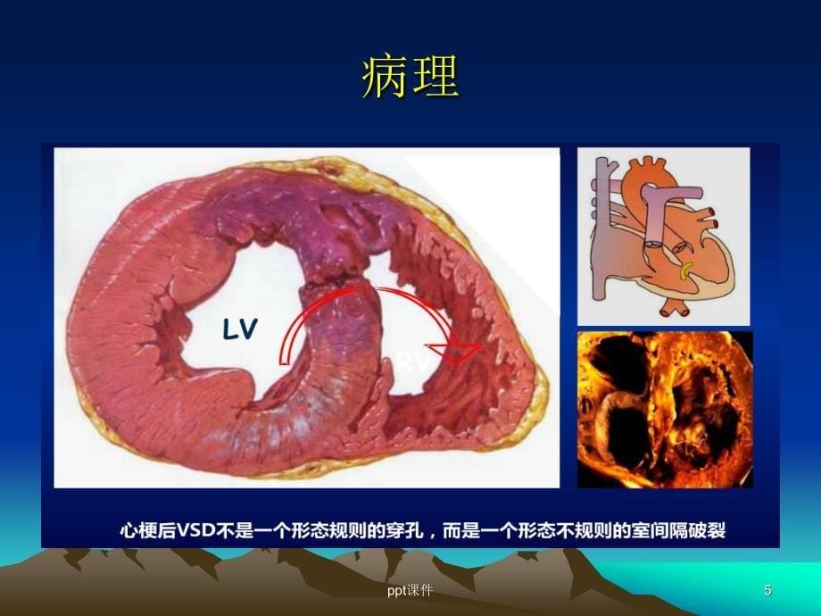 急性心肌梗死室间隔穿孔的治疗--课件_第5页