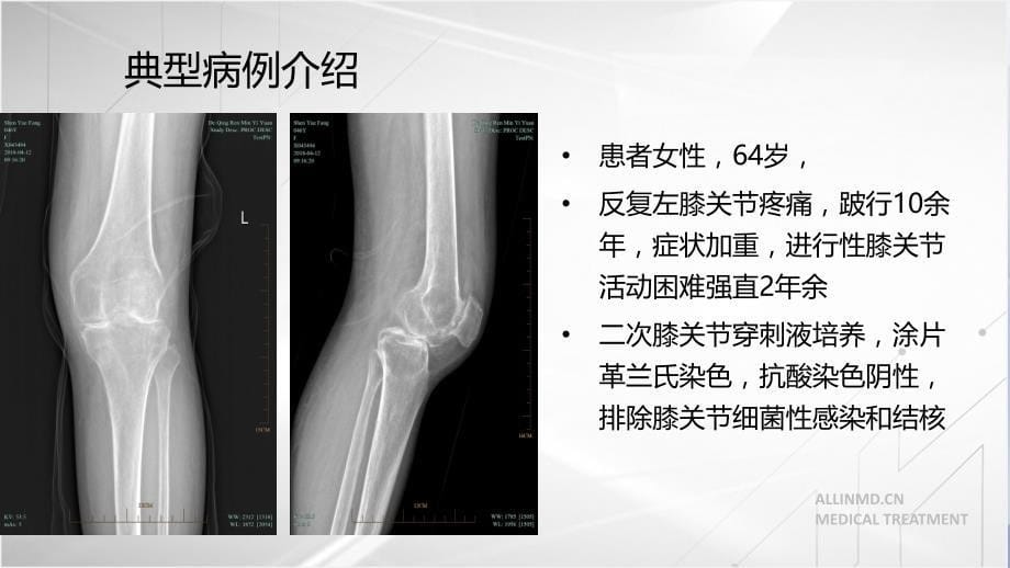 强直膝的全膝关节置换课件_第5页