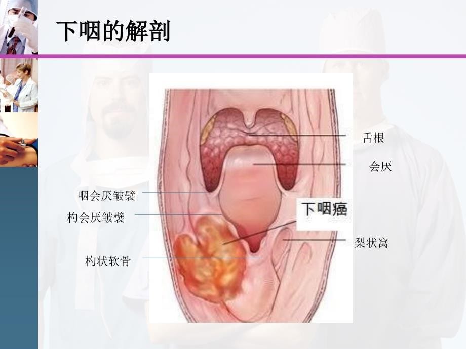 下咽癌患者护理查房课件_第5页