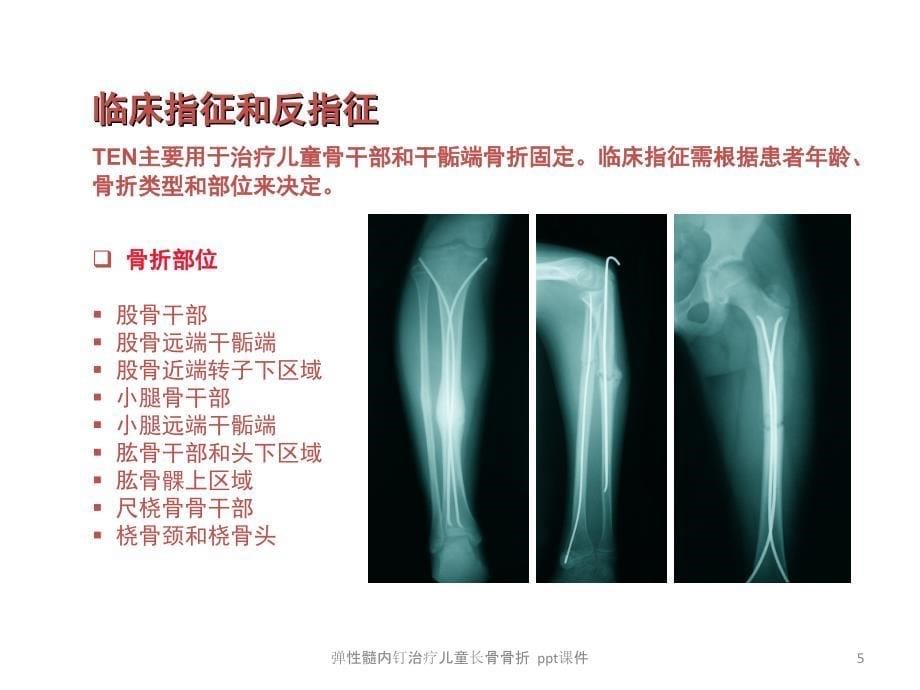 弹性髓内钉治疗儿童长骨骨折-课件_第5页