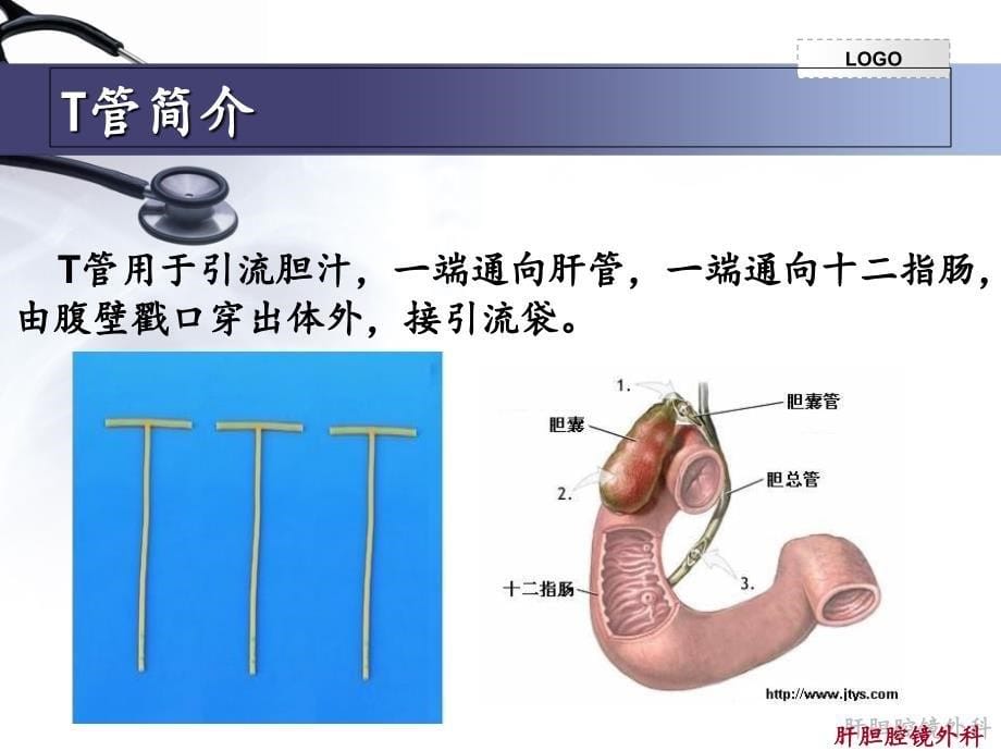 留置T管的护理-课件_第5页