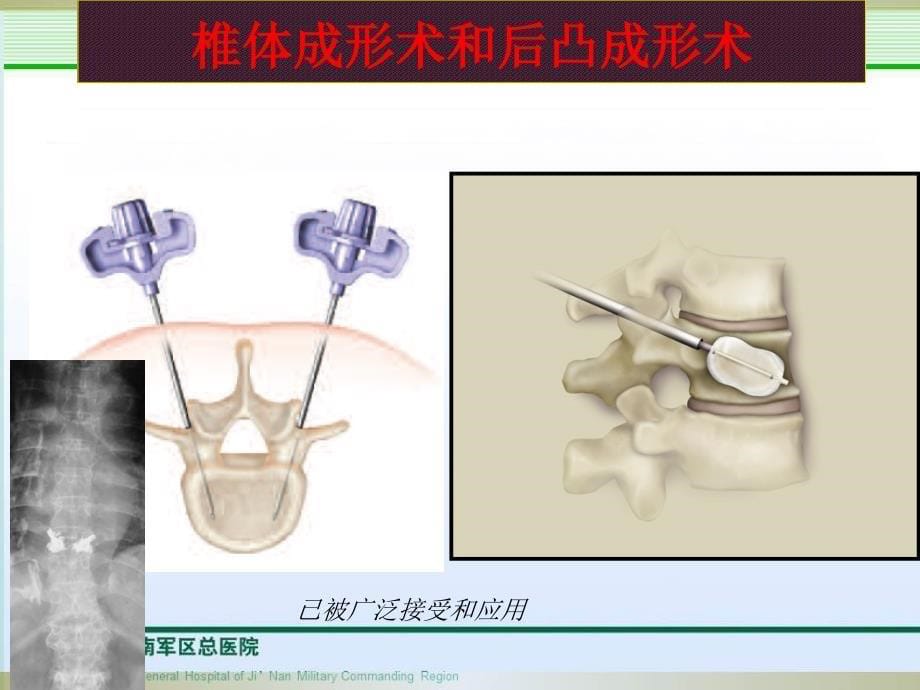 经皮椎体成形术后临床疗效因素分析与课件_第5页