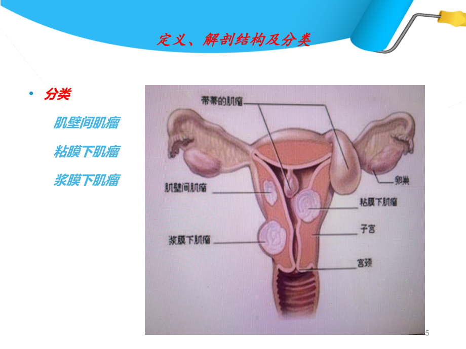 经腹子宫肌瘤挖除术课件_第5页