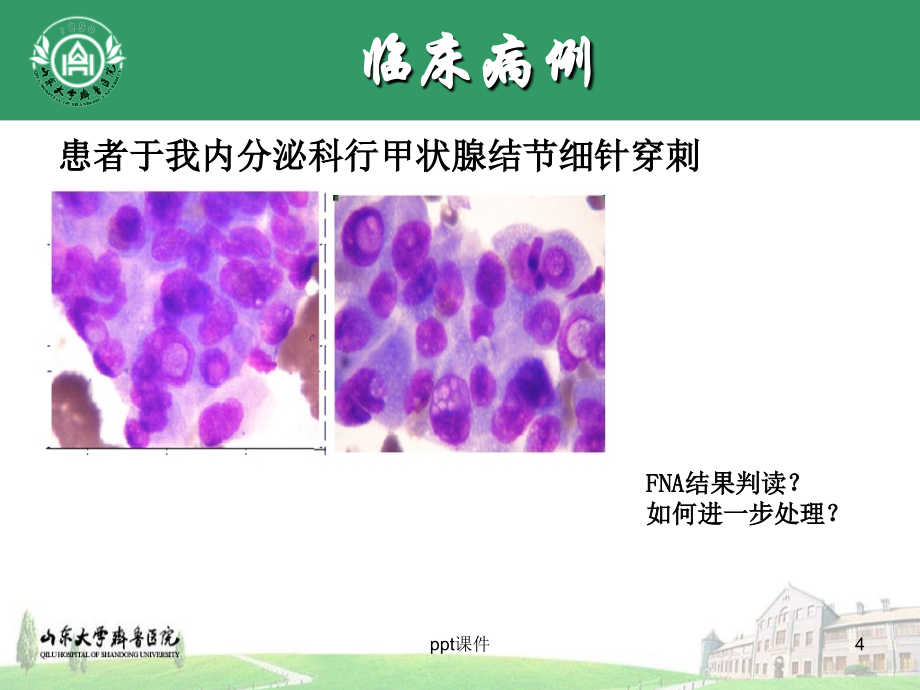 甲状腺结节诊治-多学科协作课件_第4页