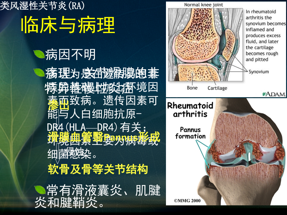 慢性关节病、退行性骨关节病的影像诊断课件_第4页