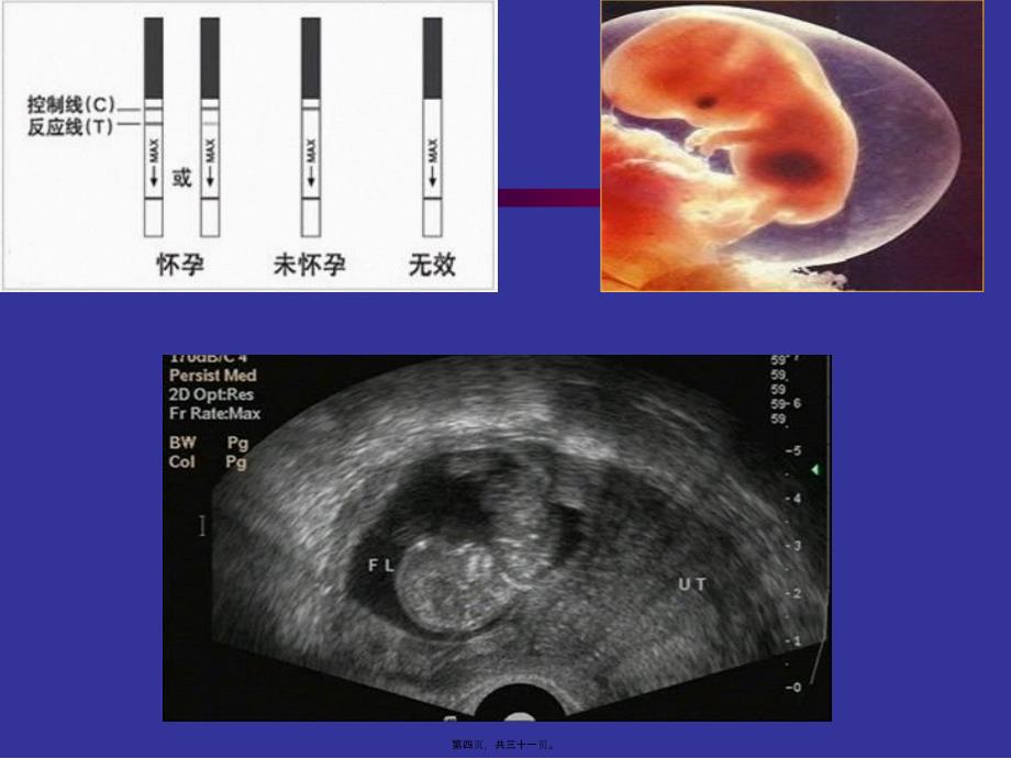 妊娠病总论-上传整理课件_第4页