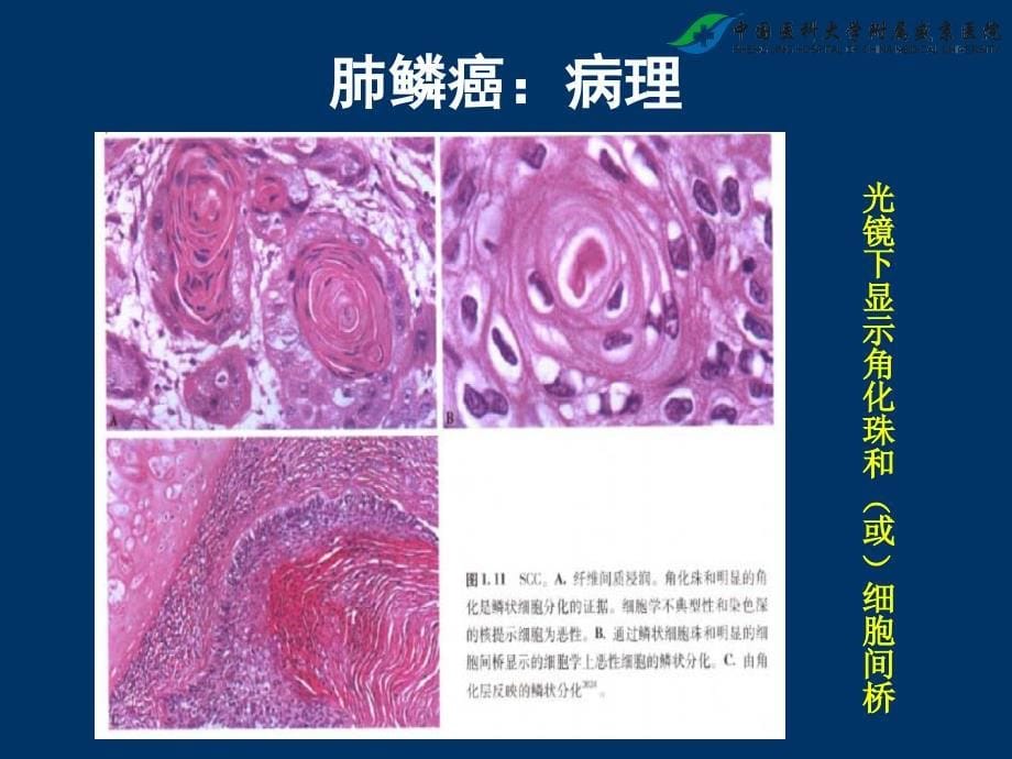 肺鳞癌诊疗课件_第5页