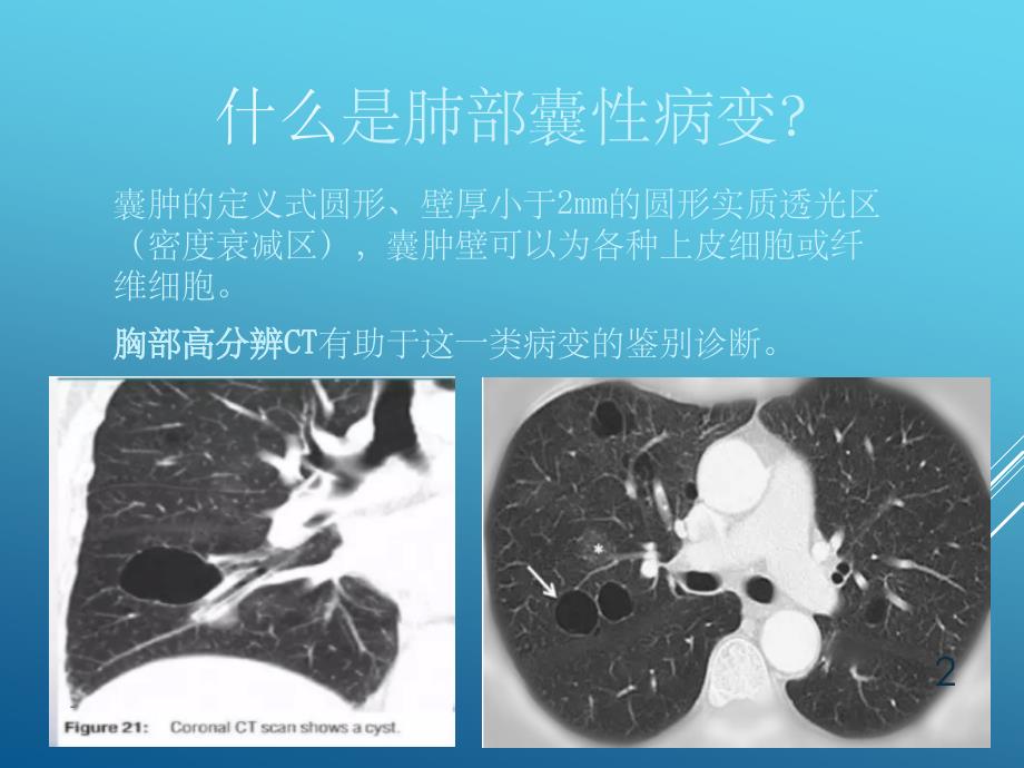 肺部囊性疾病课件_第2页