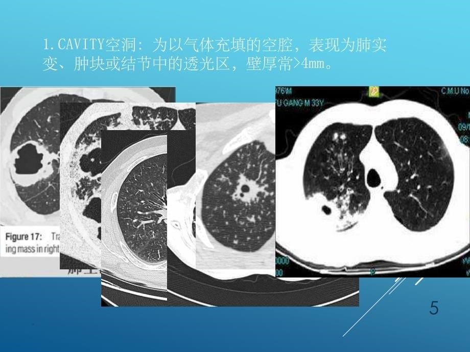 肺部囊性疾病课件_第5页