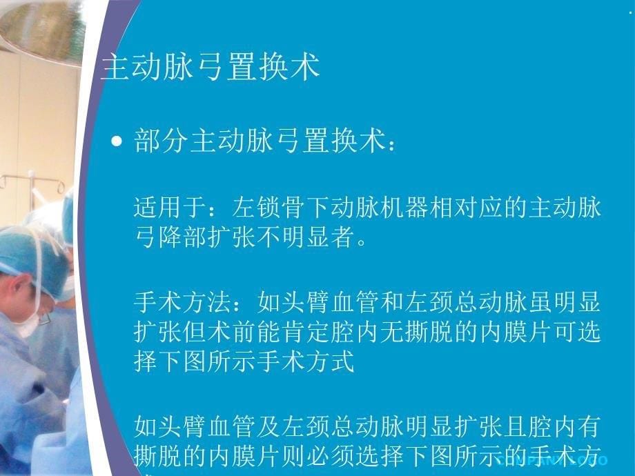 主动脉弓置换象鼻支架术后护理课件_第5页