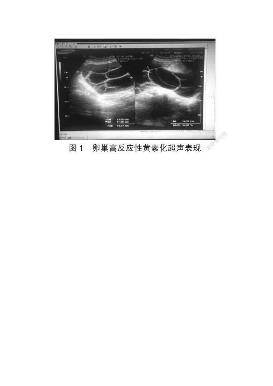 妊娠期卵巢黄素囊肿的临床分析_第2页