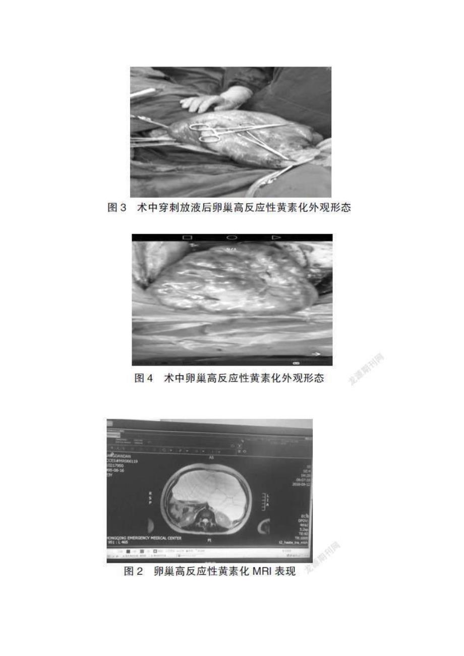 妊娠期卵巢黄素囊肿的临床分析_第3页