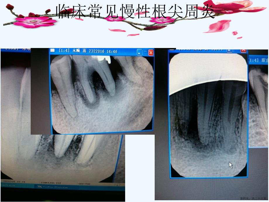 手用器械根管预备课件_第4页