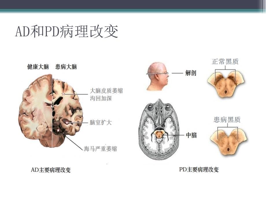 老年神经退行性疾病简单介绍课件_第5页