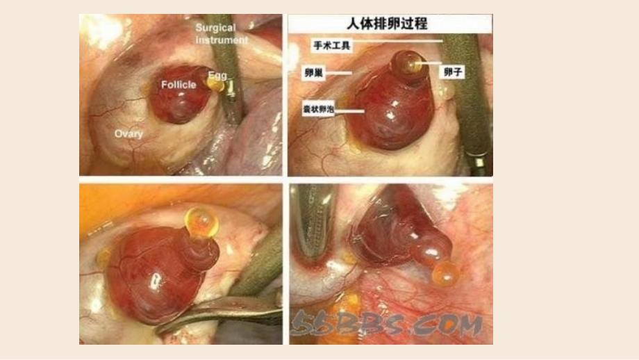 卵巢黄体破裂-ppt课件_第4页