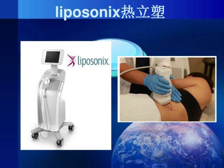 《Liposonix热立塑》PPT课件_第2页